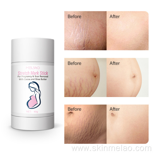 Pregnancy Removal Scars Prevention Stretch Cream Stick